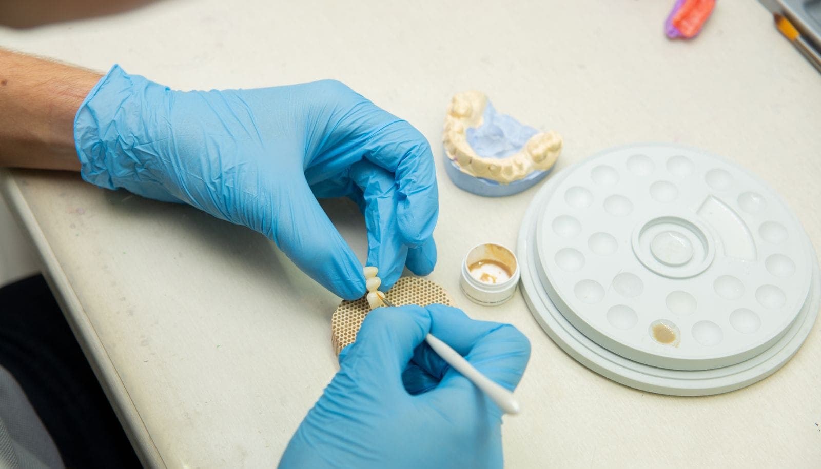Zirconia Crowns in Albania: An Honest Guide to Materials