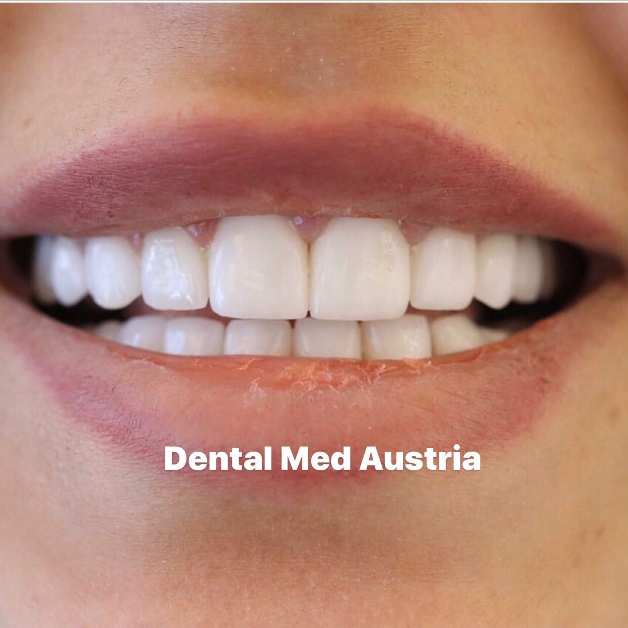 Smile transformation at Dental Med Austria, patient result 24