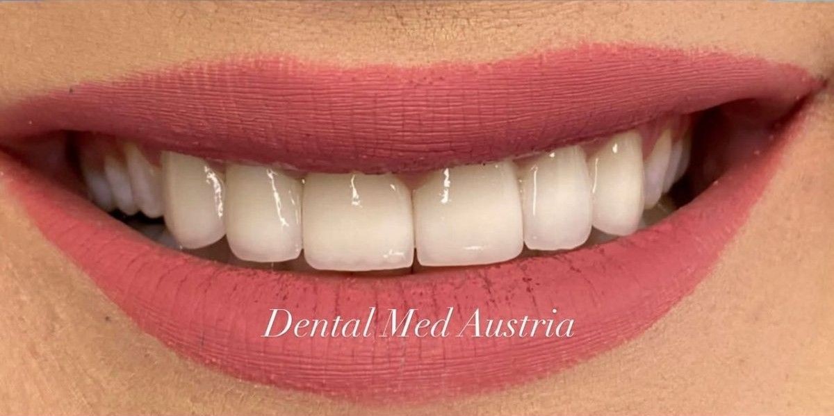 Before and after smile transformation at Dental Med Austria, result 1