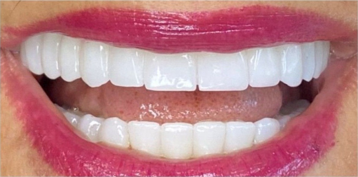 Before and after smile transformation at Dental Med Austria, result 4