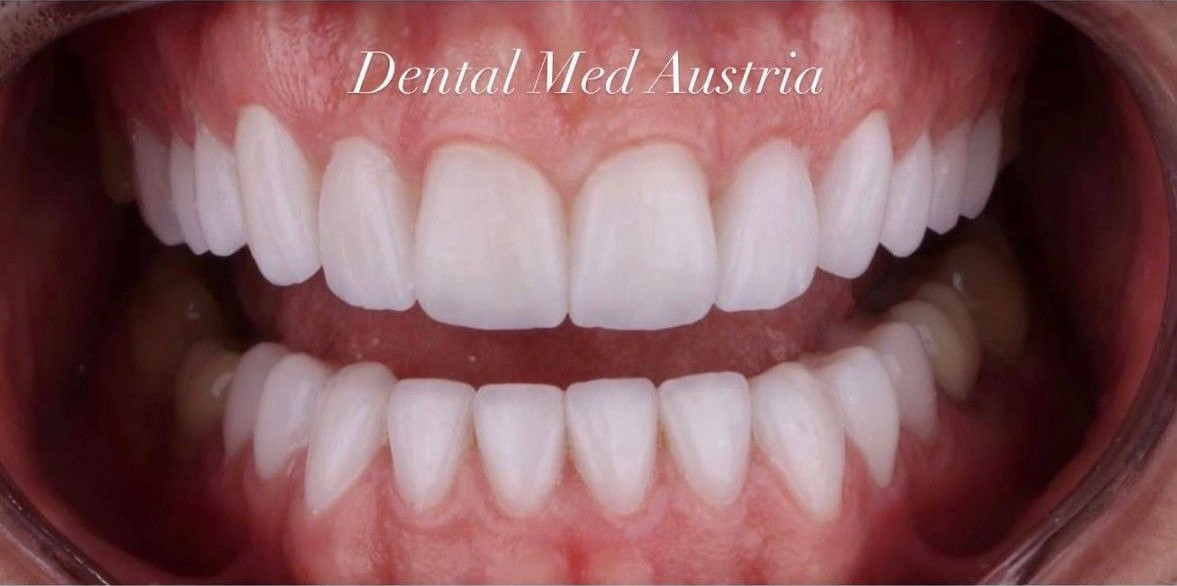 Before and after smile transformation at Dental Med Austria, result 3