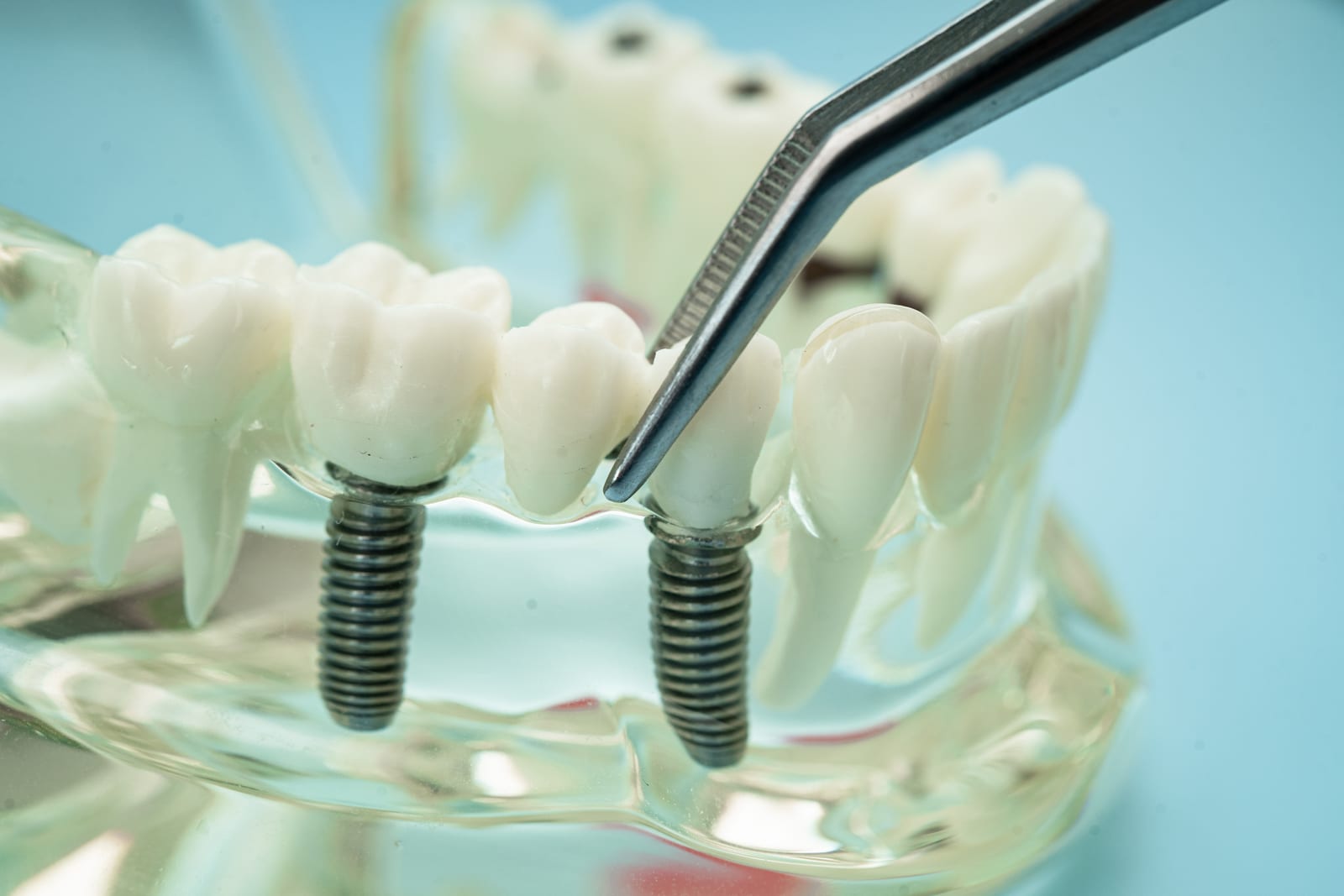 Dental implant model showing two titanium implants supporting a fixed dental bridge, examined with a metal dental tool