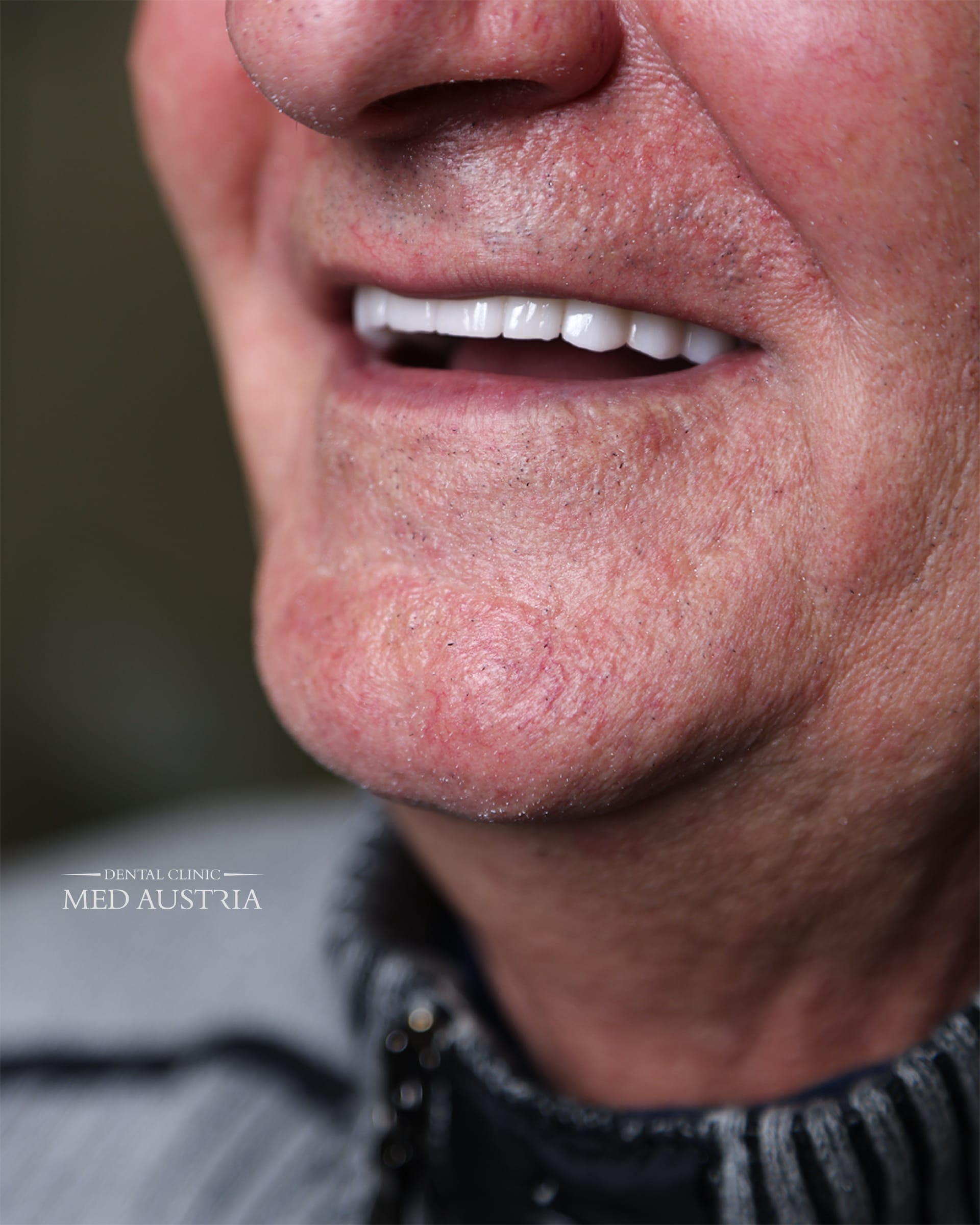 Smile transformation at Dental Med Austria, patient result 11