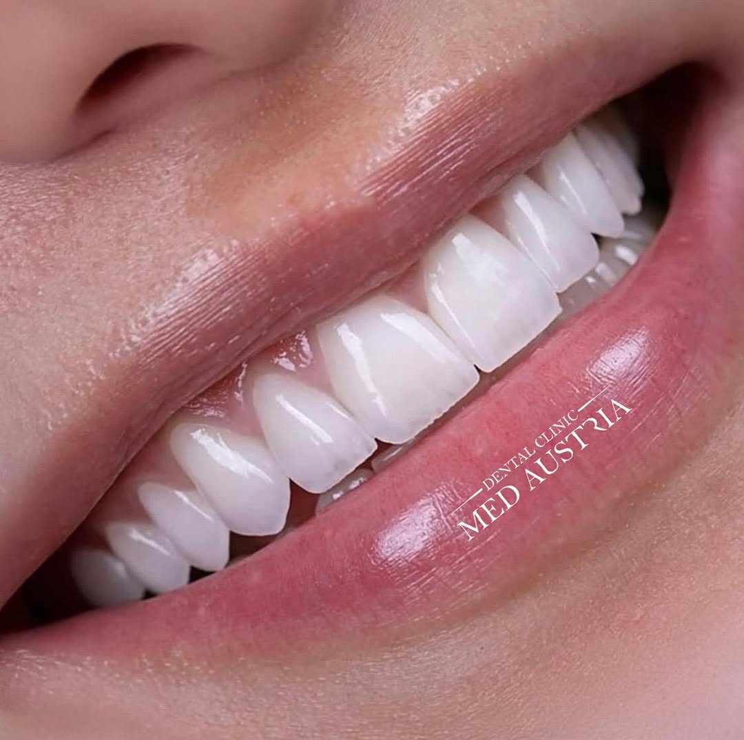 Smile transformation at Dental Med Austria, patient result 2