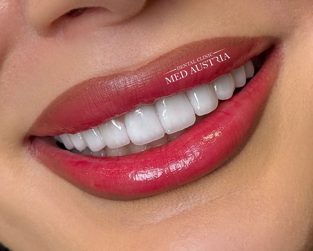 Smile transformation at Dental Med Austria, patient result 17