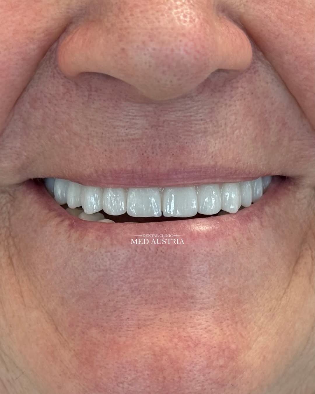 Smile transformation at Dental Med Austria, patient result 21